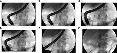 Endoscopic treatment of pancreaticopleural fistulas